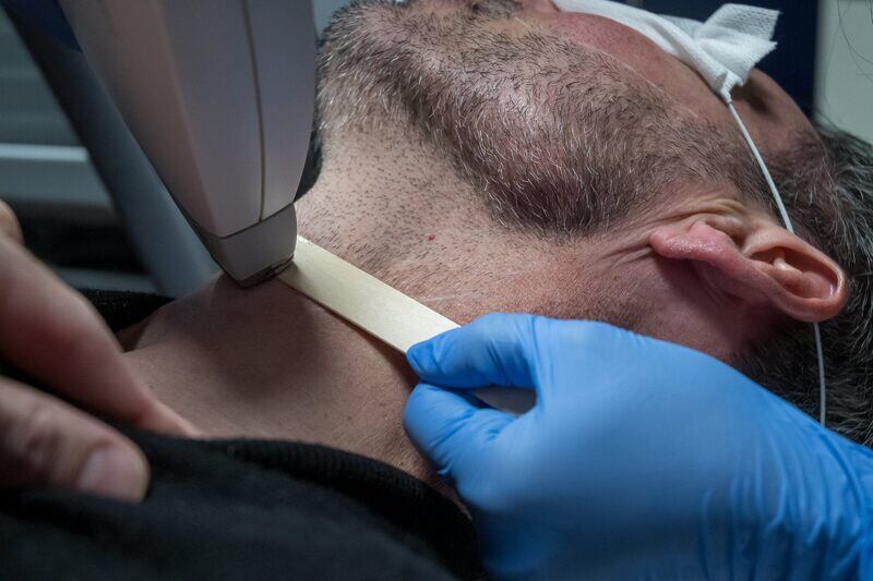 Professional laser hair removal treatment for men's beard and facial hair using Manzer diode laser technology at DIDA Hair Studio Queens NYC